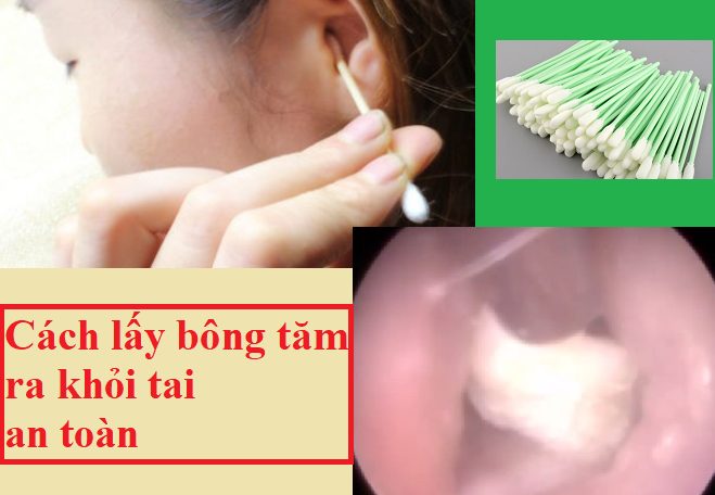 Cách lấy bông gòn tăm kẹt trong lỗ tai khi ráy sâu bên trong an toàn